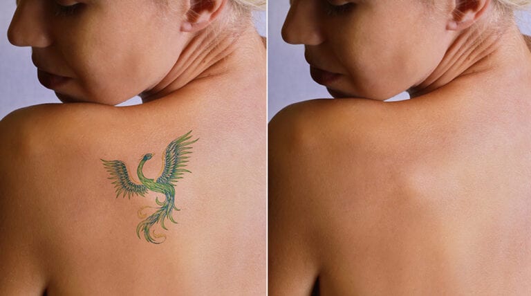 Will Pico Laser Treatment Remove Tattoo Completely?