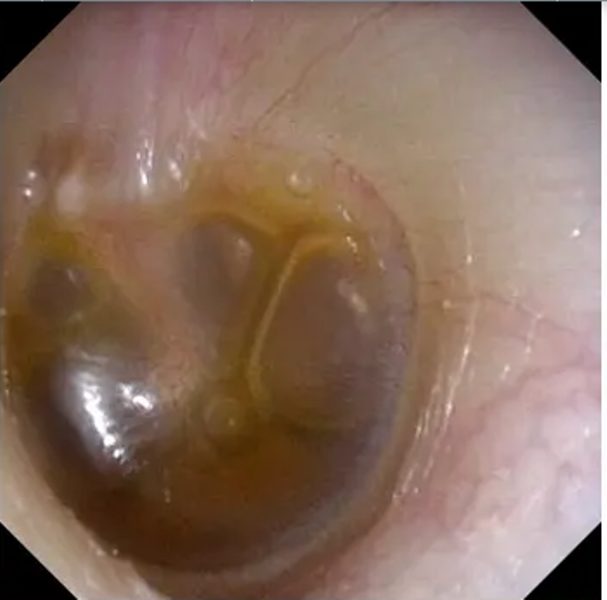 Treat Ear Conditions