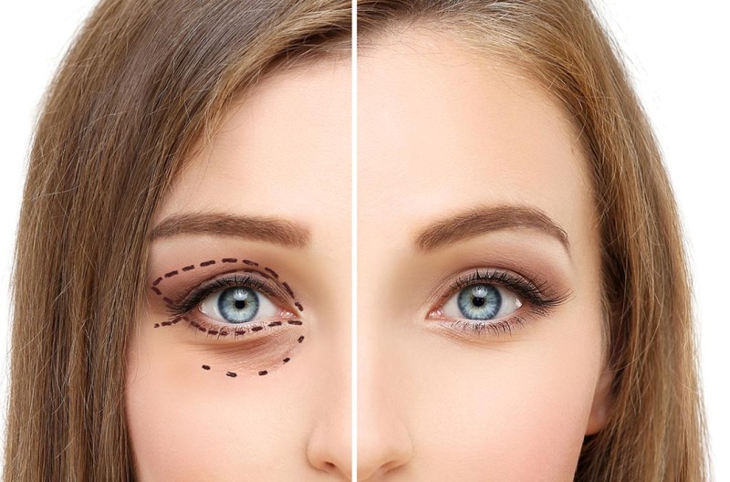 Blepharoplasty