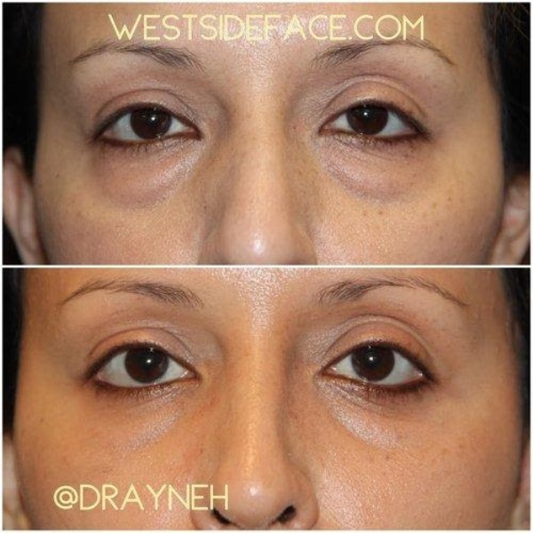Wrinkles in Lower Eyelids