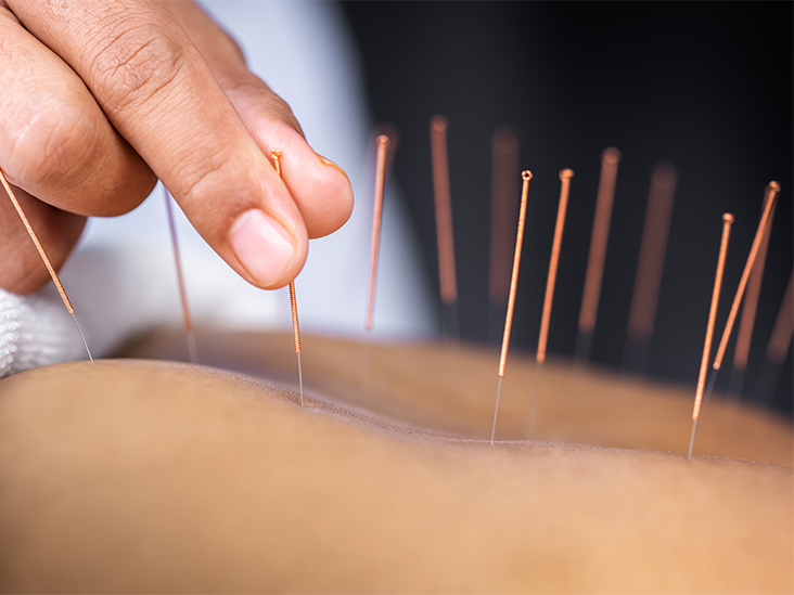 Acupuncture 1