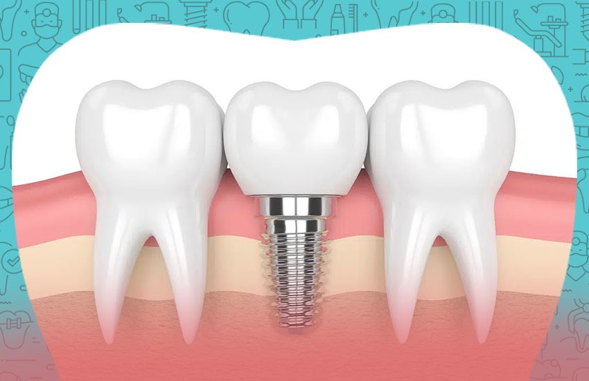 Advanced Dental Implant Training 2